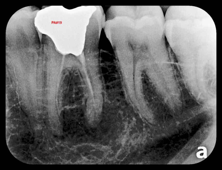 Digital X-ray of teeth | Lakeforest Dental Associates