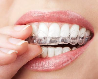 Woman putting in her Invisalign tray