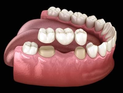 graphic of a dental bridge