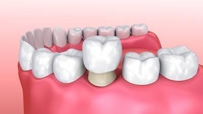 Diagram of a dental crown in Gaithersburg, MD