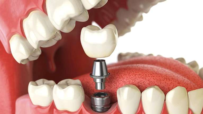 Dental implant diagram