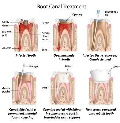 root canal treatment in Gaithersburg MD