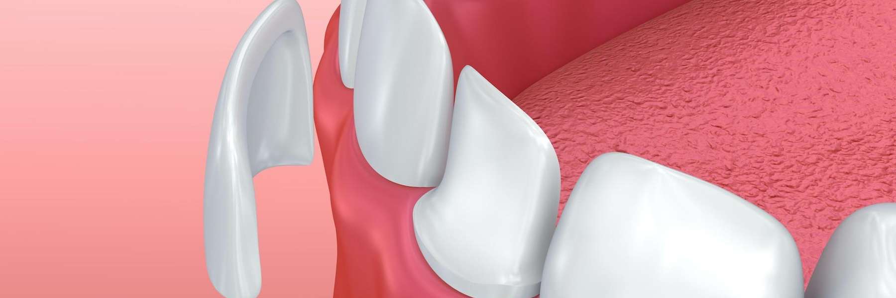 Porcelain Veneers