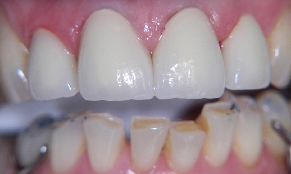 Dental Crown Restoration in Gaithersburg MD