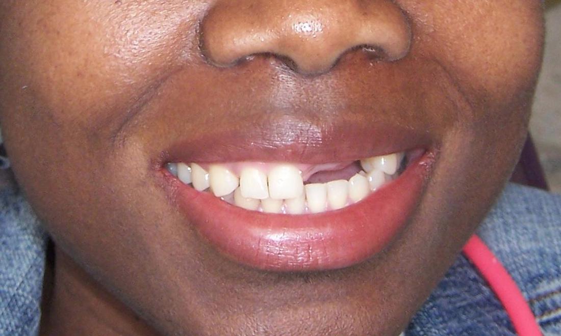 Dental Implant Restorations in Gaithersburg MD