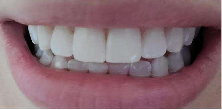 Teeth whitening Gaithersburg- after photo