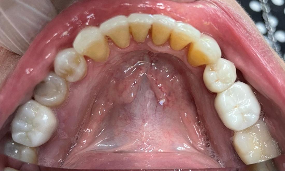 Patient lower row of teeth after Invisalign correction