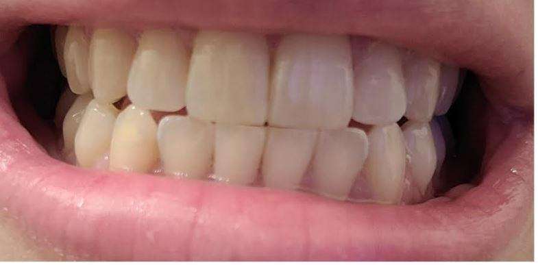 Teeth whitening Gaithersburg- before photo