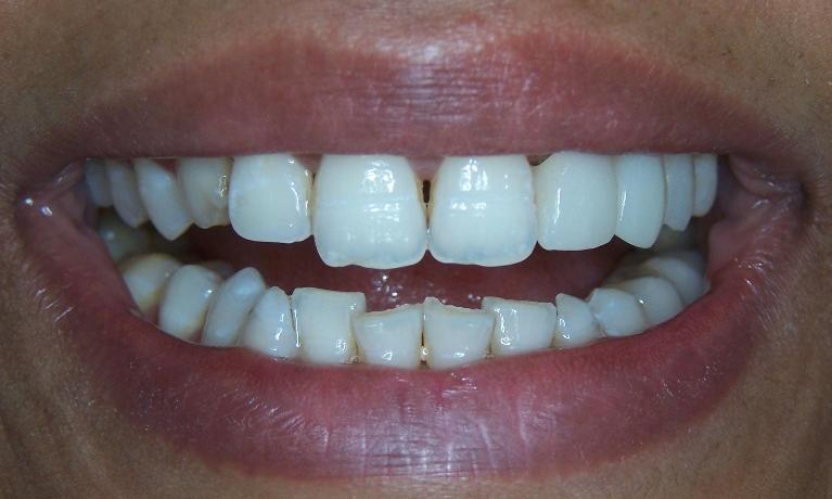 Missing-Tooth-Replacement-in-Gaithersburg-MD-After-Image