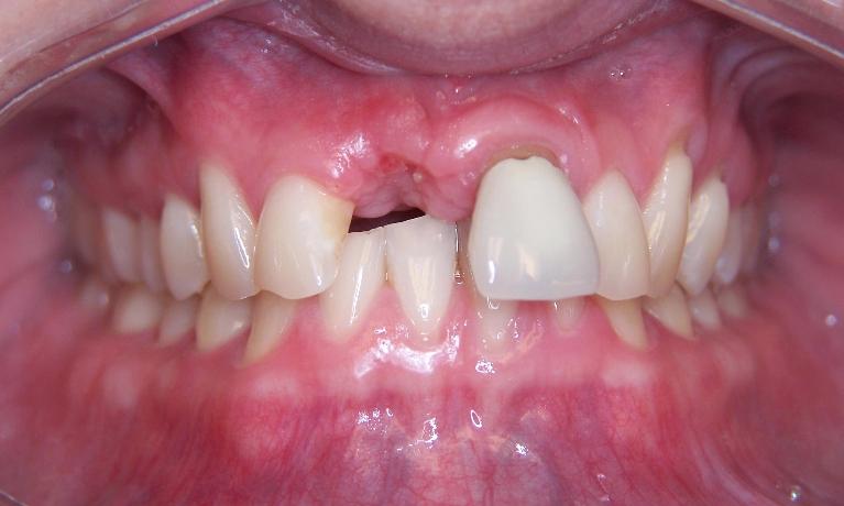 Dental-Implant-in-Gaithersburg-MD-Before-Image