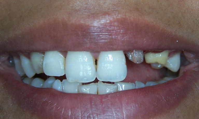 Missing-Tooth-Replacement-in-Gaithersburg-MD-Before-Image