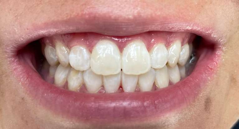 In-Office-Teeth-Whitening-After-Image