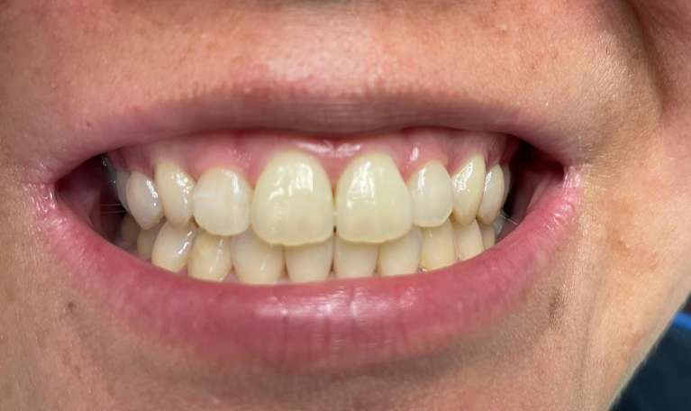 In-Office-Teeth-Whitening-Before-Image