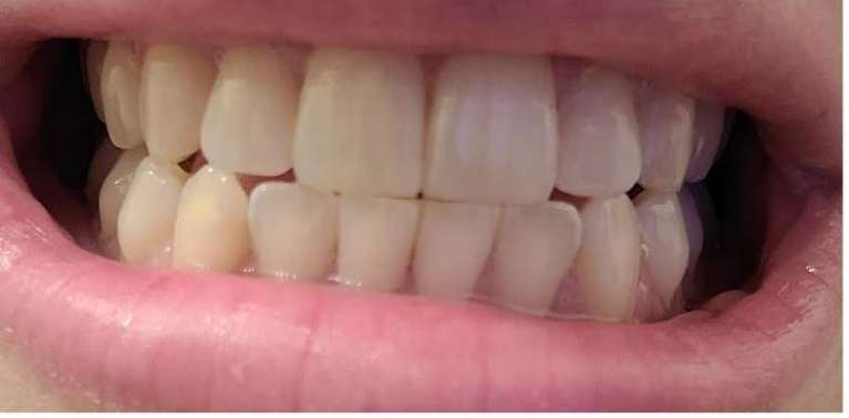 In-Office-Teeth-Whitening-Before-Image