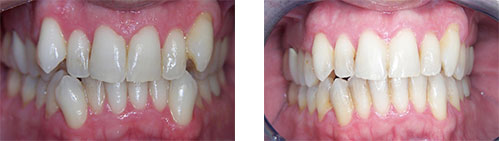 Before and After Pictures of Teeth