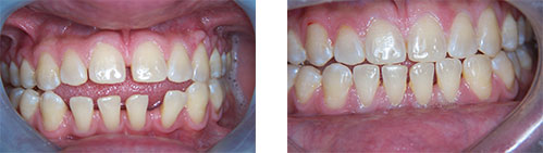 Before and after photo of patient's smile