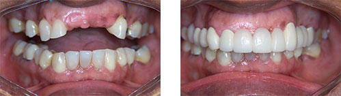 a before and after image of dental implants | Gaithersburg MD dentist